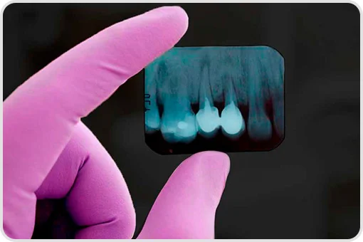 Periapical dental x-ray held by dentist with pink gloves, used for diagnosis in office near me in Coyoacán, CDMX.
