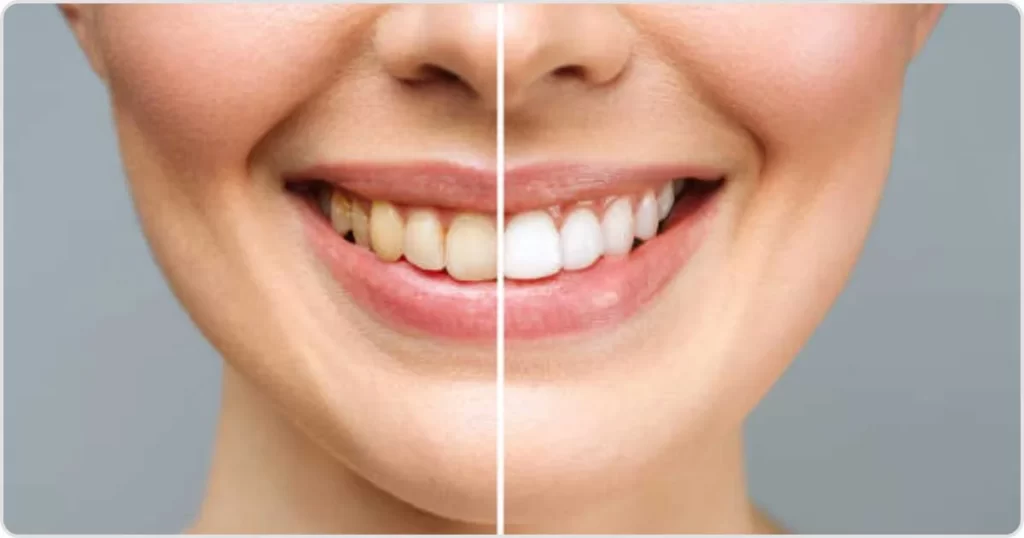 blanqueamiento dental precio profesional en CDMX; comparación antes y después con sonrisa visiblemente más blanca.