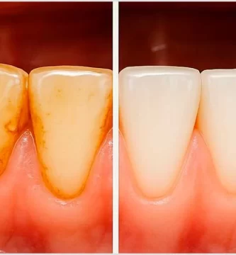 how to remove tartar from teeth in 5 minutes. Comparison of before and after removing tartar from teeth, showing healthy gums and clean teeth after dental cleaning in Coyoacán.