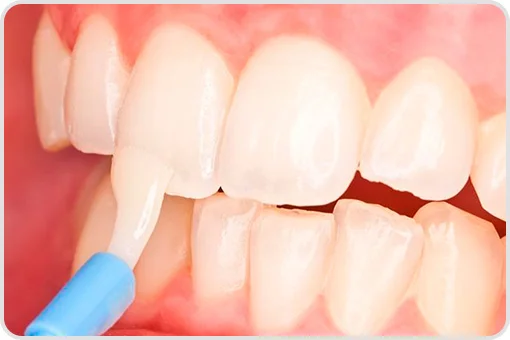 Aplicación de flúor tópico al final de una limpieza dental profesional en consultorio de Coyoacán CDMX