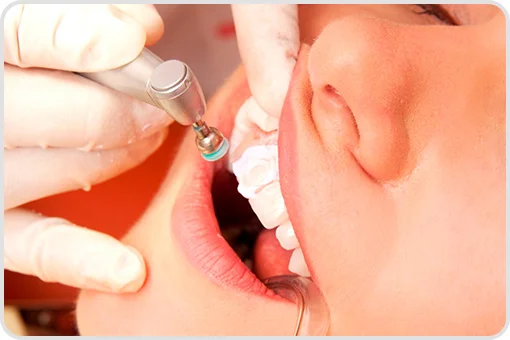 Procedimiento de limpieza dental con pulido profesional en consultorio de Coyoacán CDMX